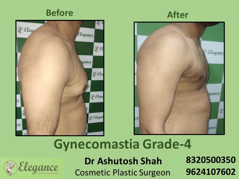 Male Fat Reduction | Male Gynecomastia Grade 4 Treatment, Pal , Surat