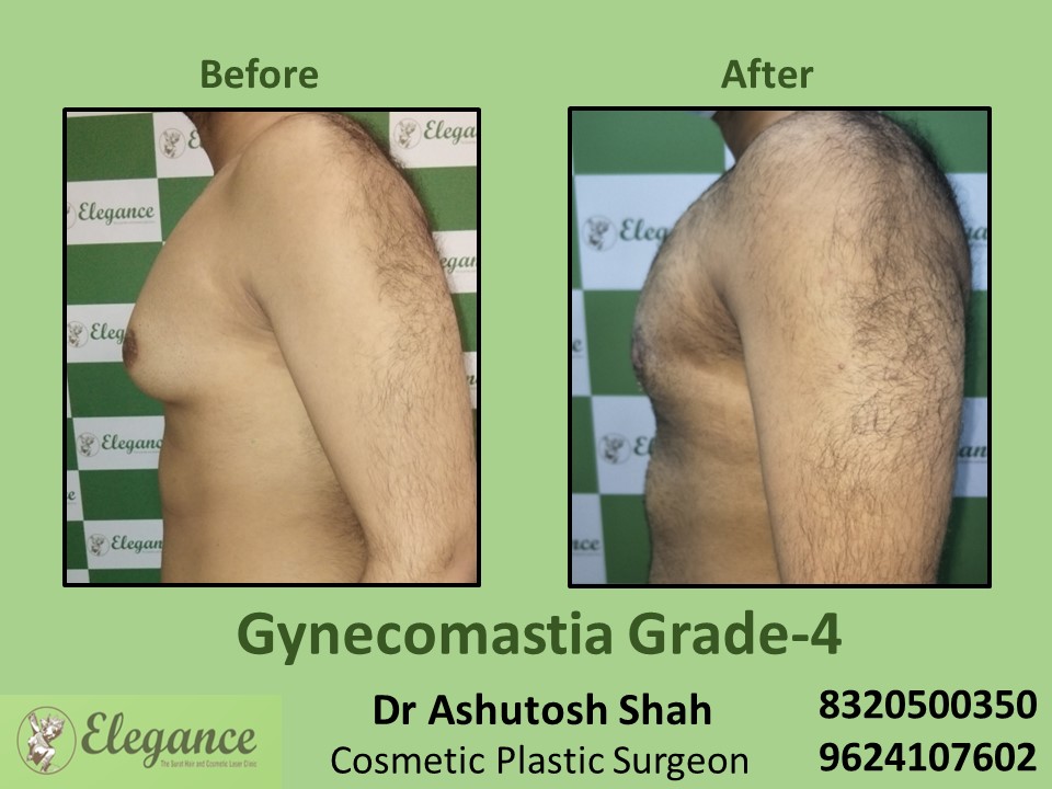 Male Fat Reduction | Gynecomastia Grade 4 Treatment, Pal , Rander, Surat