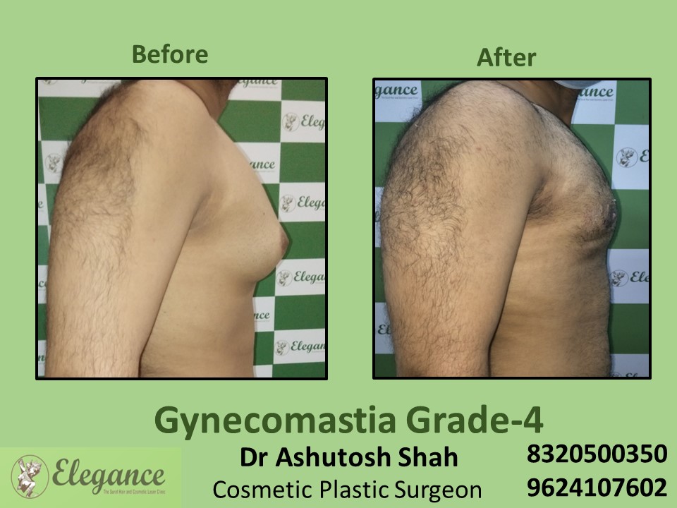 Male Fat Reduction | Gynecomastia Grade 4 Treatment, Rander, Surat