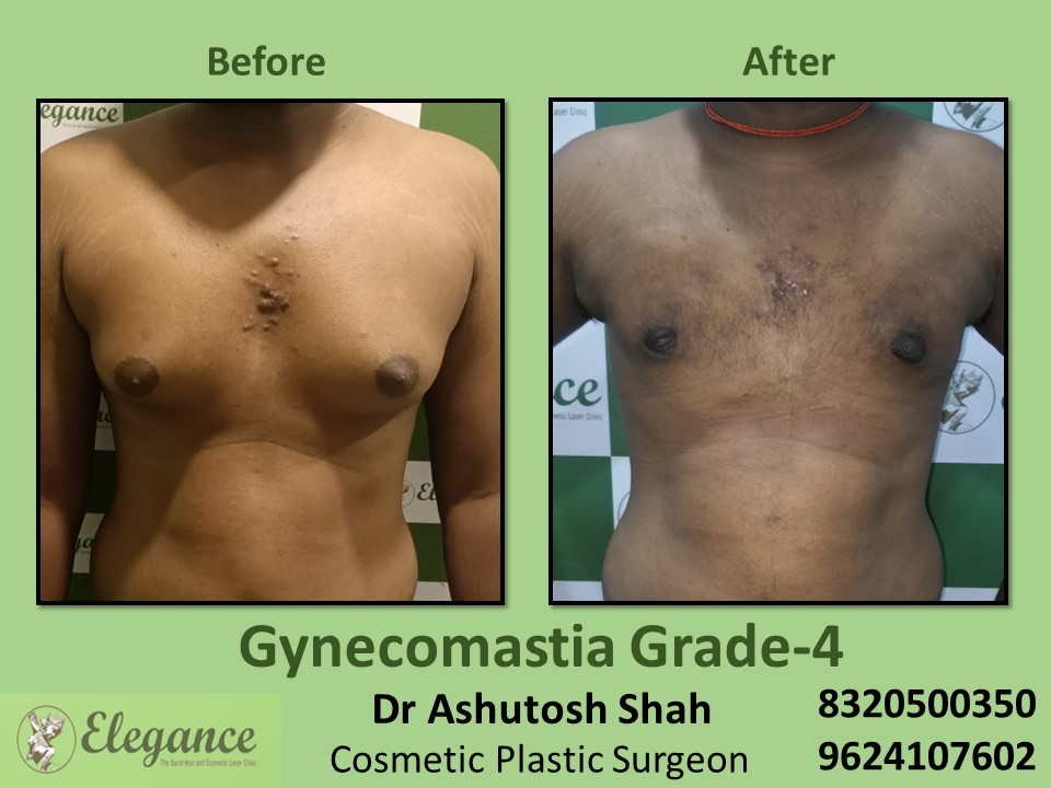 Male Boobs Reduction | Grade 4 Gynecomastia Treatment in Piplod, Surat