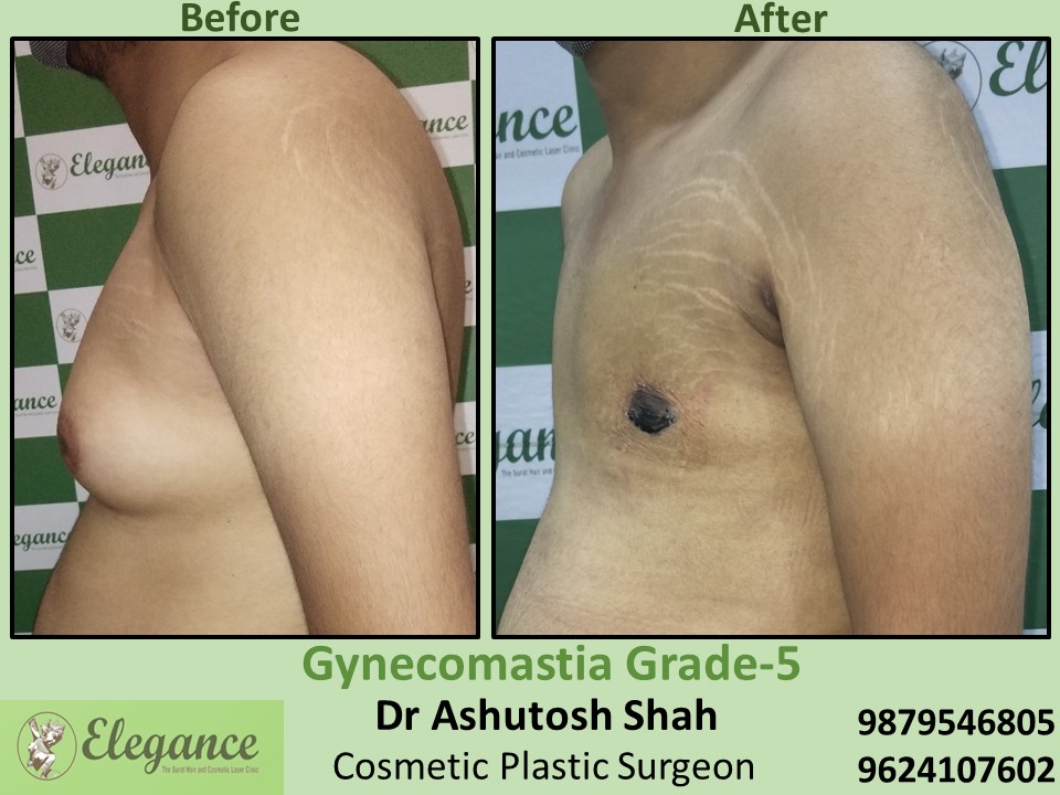 Best Hospital for Cosmetic Surgery, Gynecomastia in Surat, Gujarat