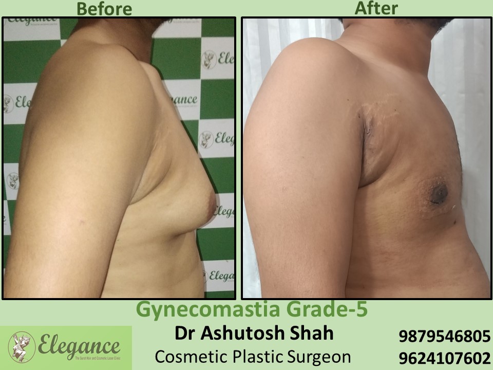 Best treatment for Male breast in Majuragate, Surat