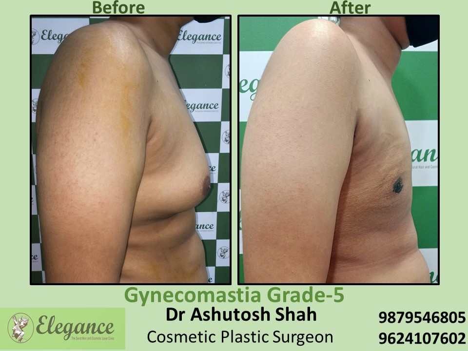 Big breast removal treatment from male in Hazira, Dumas, Surat