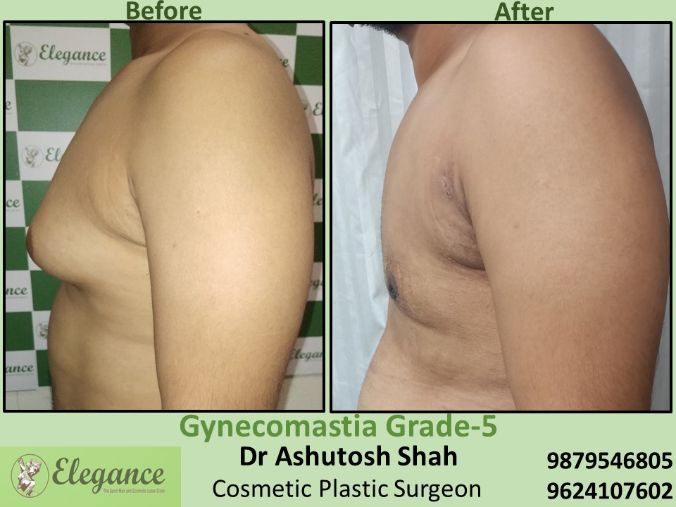 Extra fat reduction from breast in male surgery in Piplod, Surat