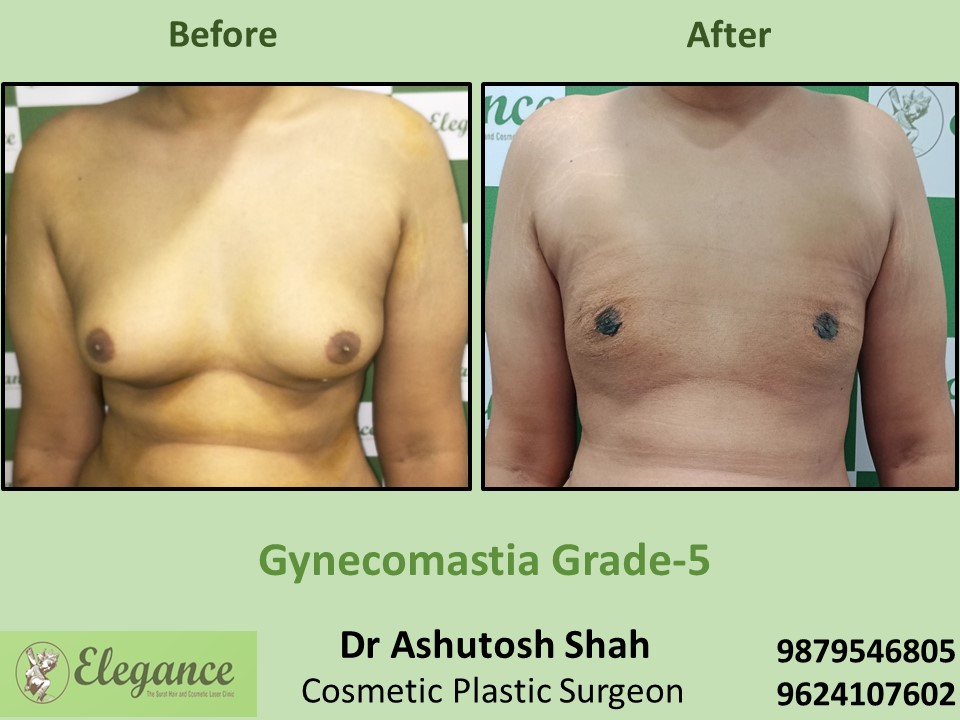 Fat removal surgery from breast in Male at Athwagate, Surat