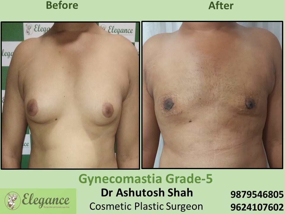 Gynecomastia in Surat, Gujarat