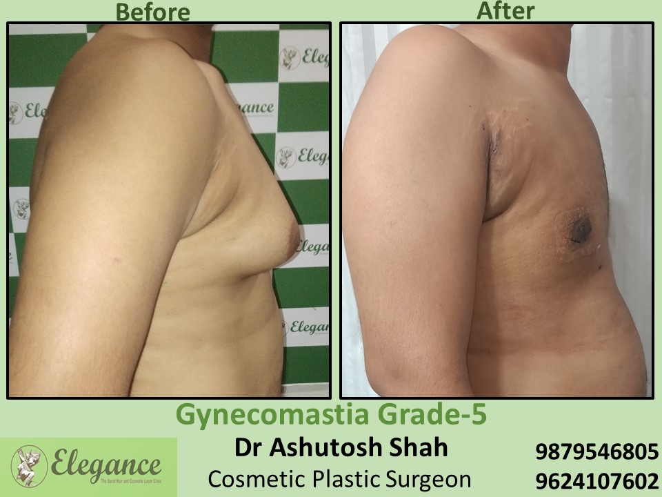 Hospital for Breast Surgery in Male at Vesu, Ghod dod Road, Surat