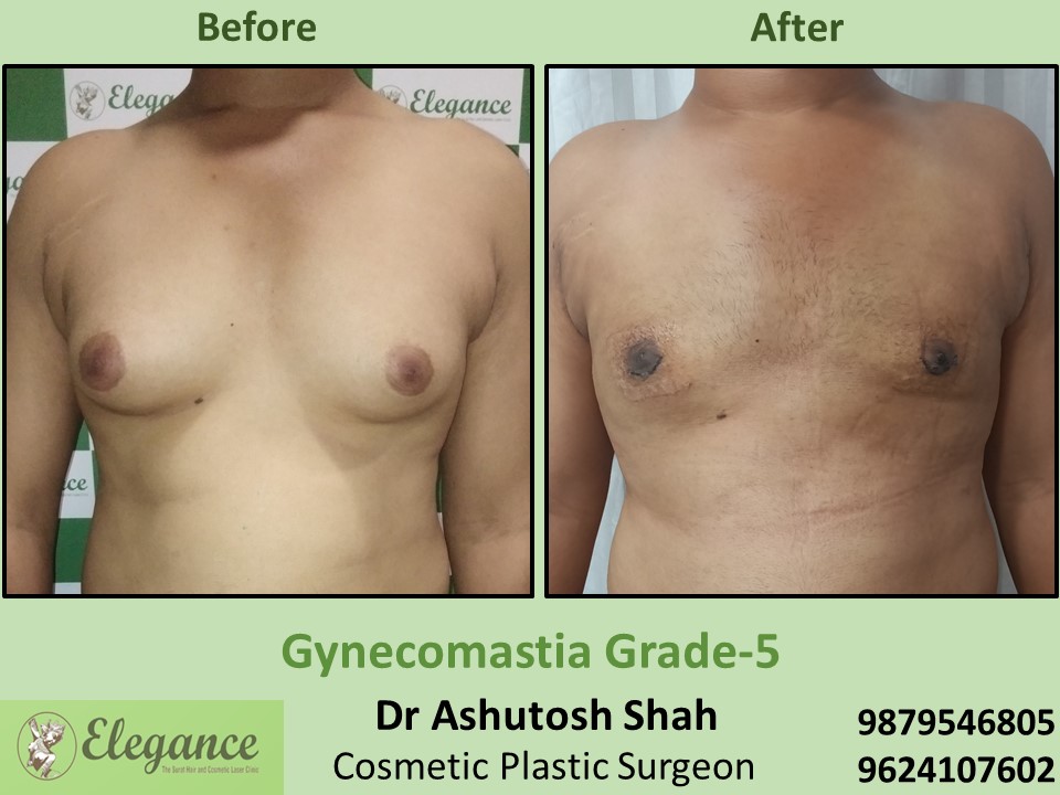 Low cost Gynecomastia for Male Treatment or Surgery in Surat