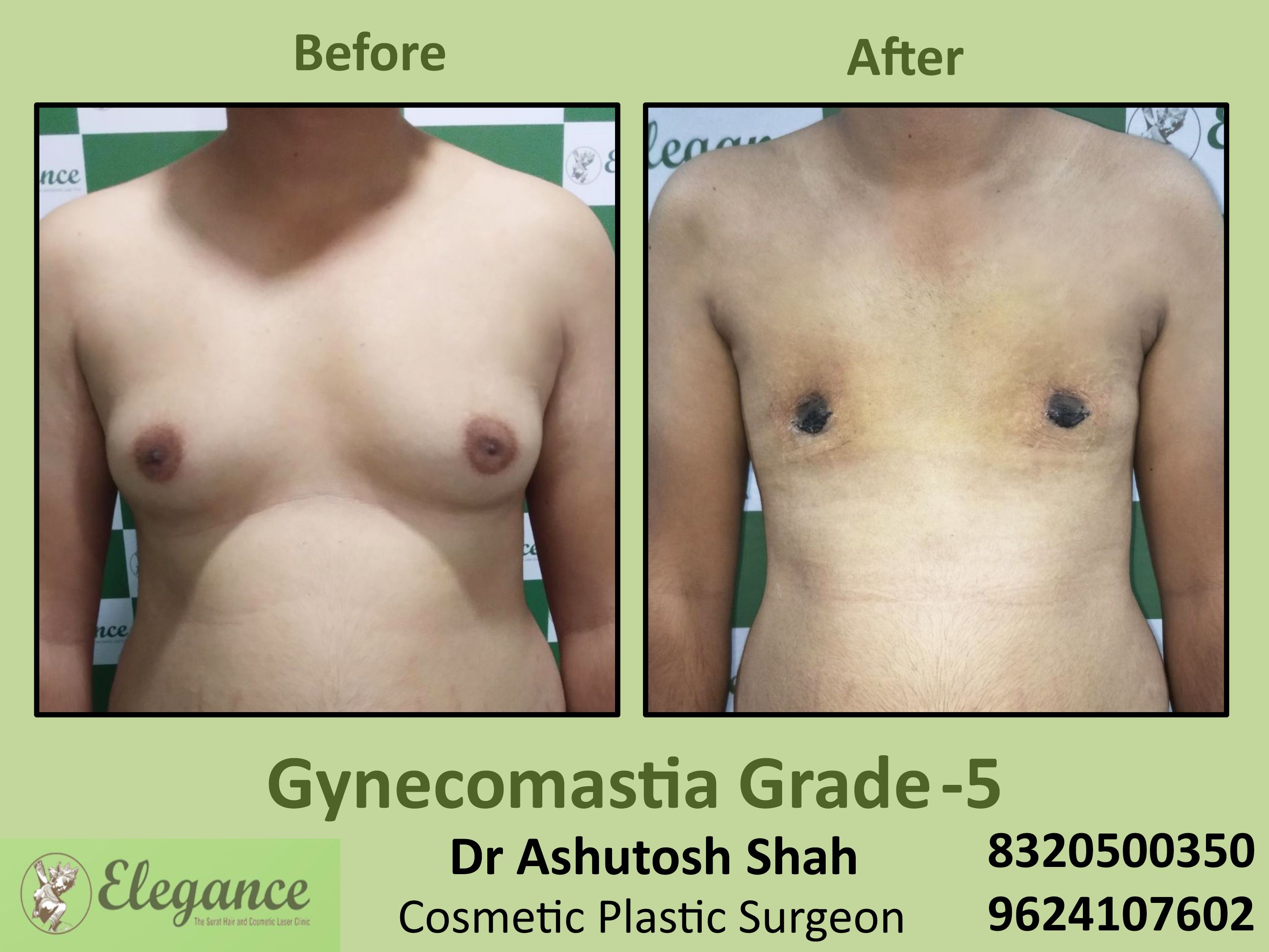 Grade 5 Gynecomastia in Piplod, Udhna Surat