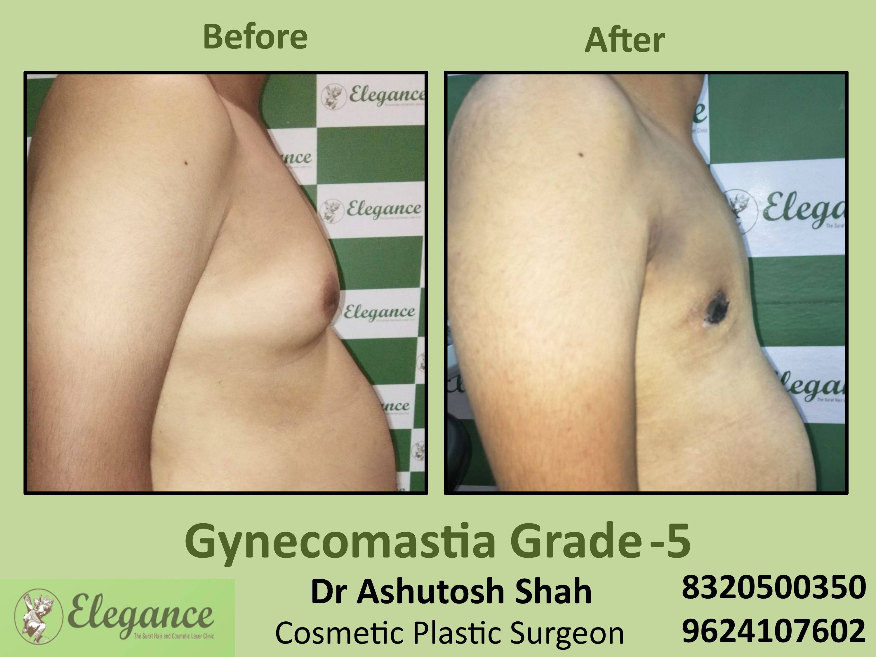 Grade 5 Gynecomastia in Udhna Surat