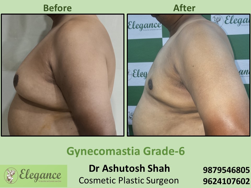 Best gynecomastia Treatment in Vesu, Adajan, Surat