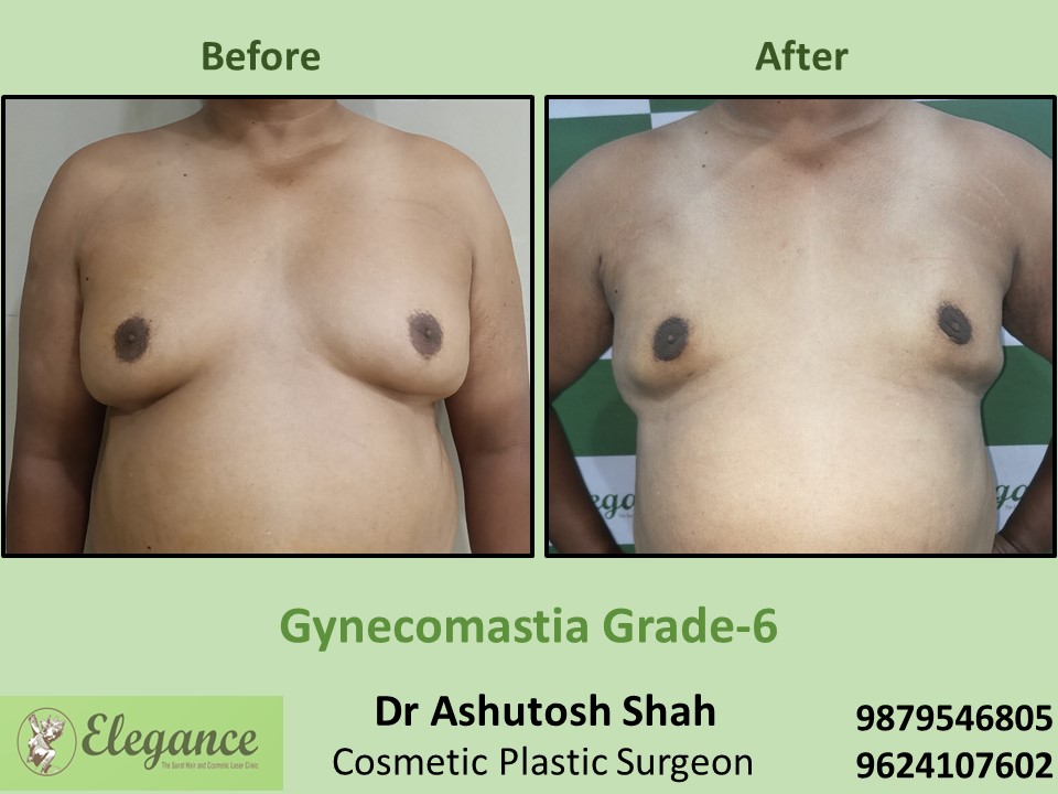Big breast treatment for male in Surat