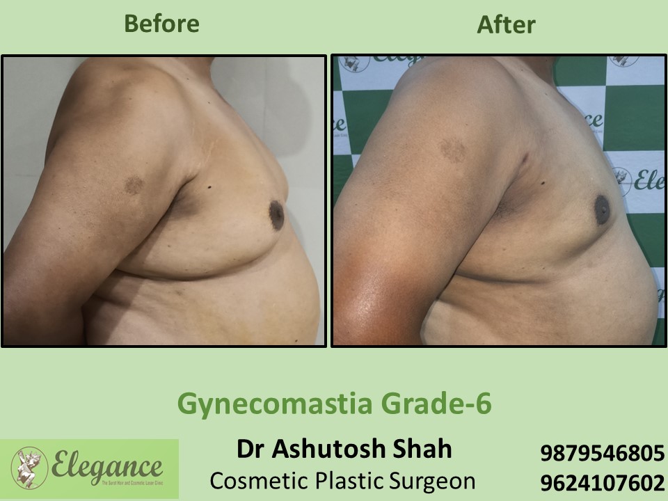 Male big boobs surgery in Surat, Gujarat