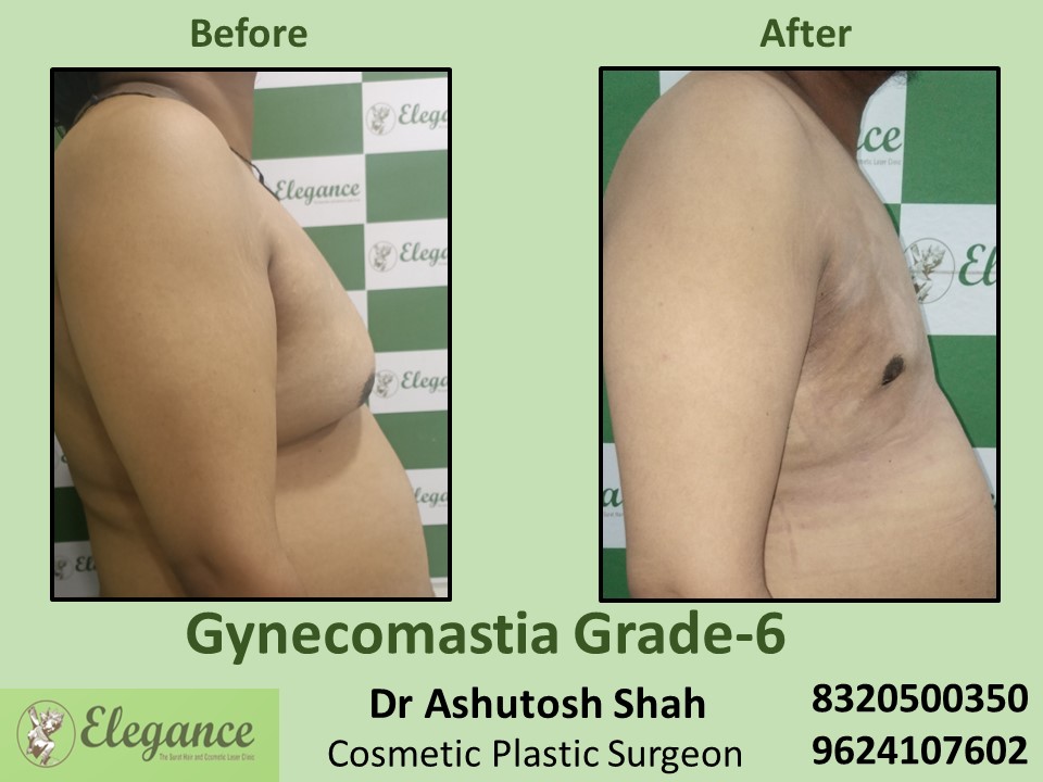 Gynecomastia Grade 6, Best Cosmetic Surgeon in Vesu, Dumas, Surat
