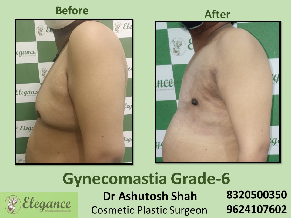 Gynecomastia Grade 6, Best Cosmetic Surgeon in Dumas, Surat