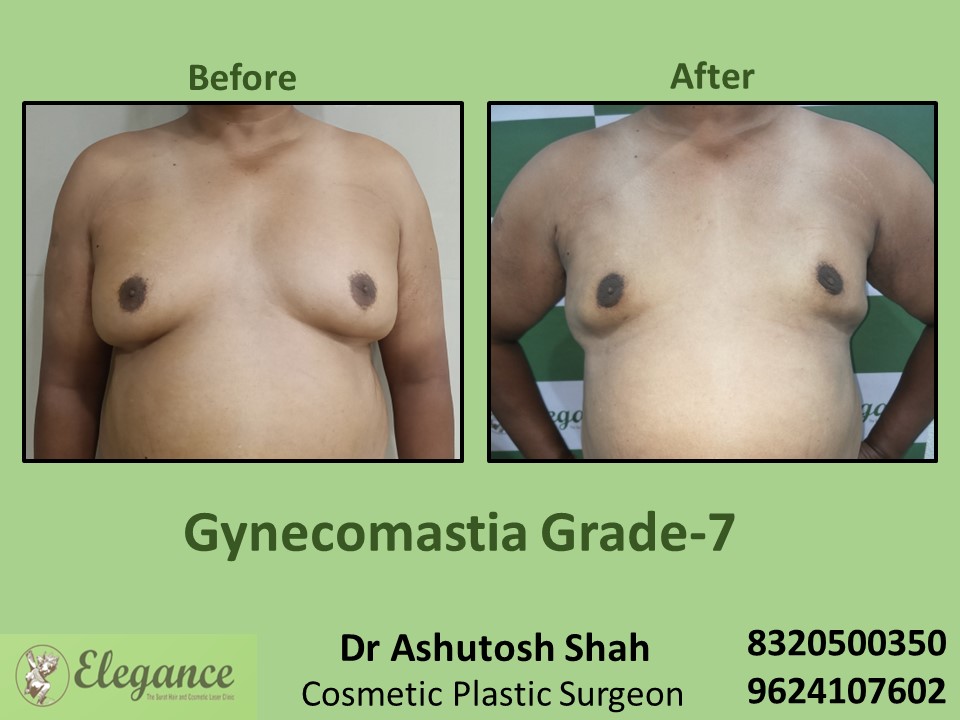 Gynecomastia Grade 7, Boobs Reduction Treatment in Vesu, Surat
