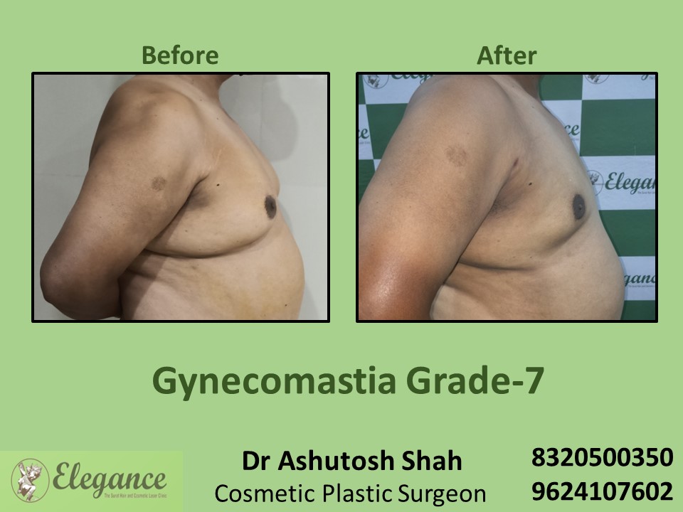 Gynecomastia Grade 7, Boobs Reduction Treatment in Vesu, Piplod, Surat