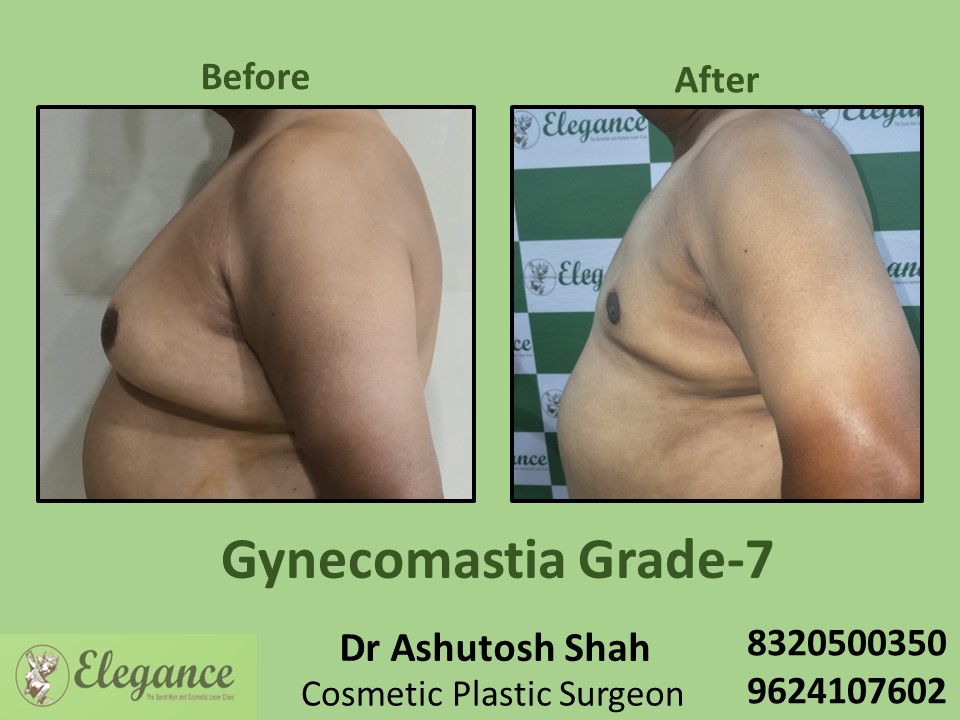 Gynecomastia Grade 7, Boobs Reduction Treatment in Piplod, Surat