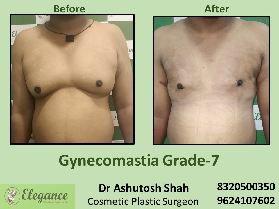 Gynecomastia Grade 7, Boobs Reduction Treatment in Dumas, Surat