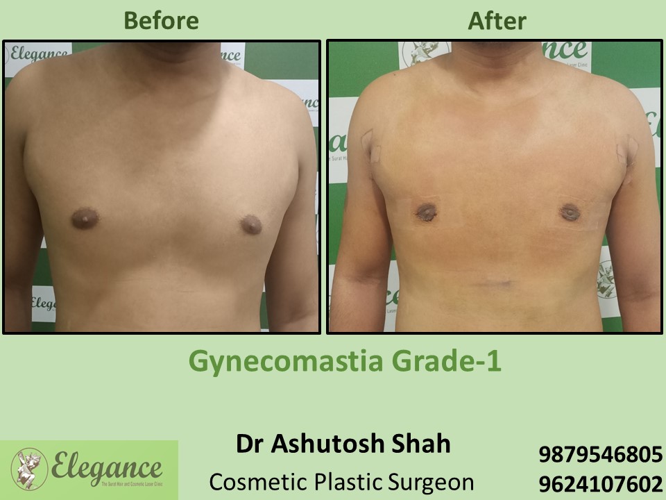 Extra Fat Reduction from Male Surgery in Surat