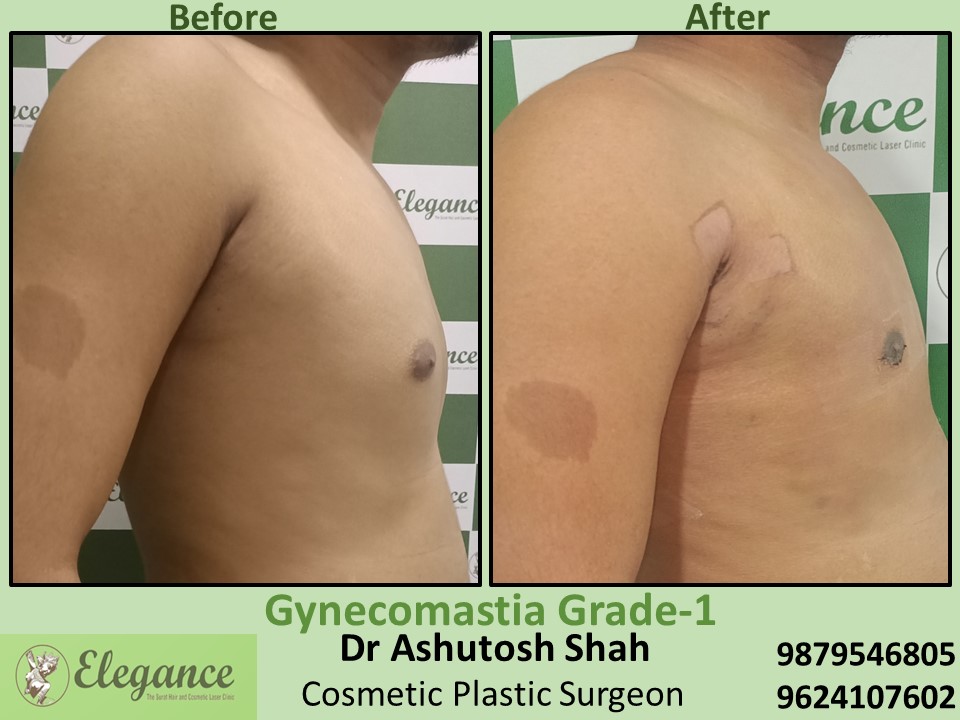 Fat Removal Treatment in Adajan, Surat