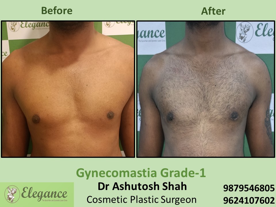 Gynecomastia Surgery in Vesu, Surat, Gujarat