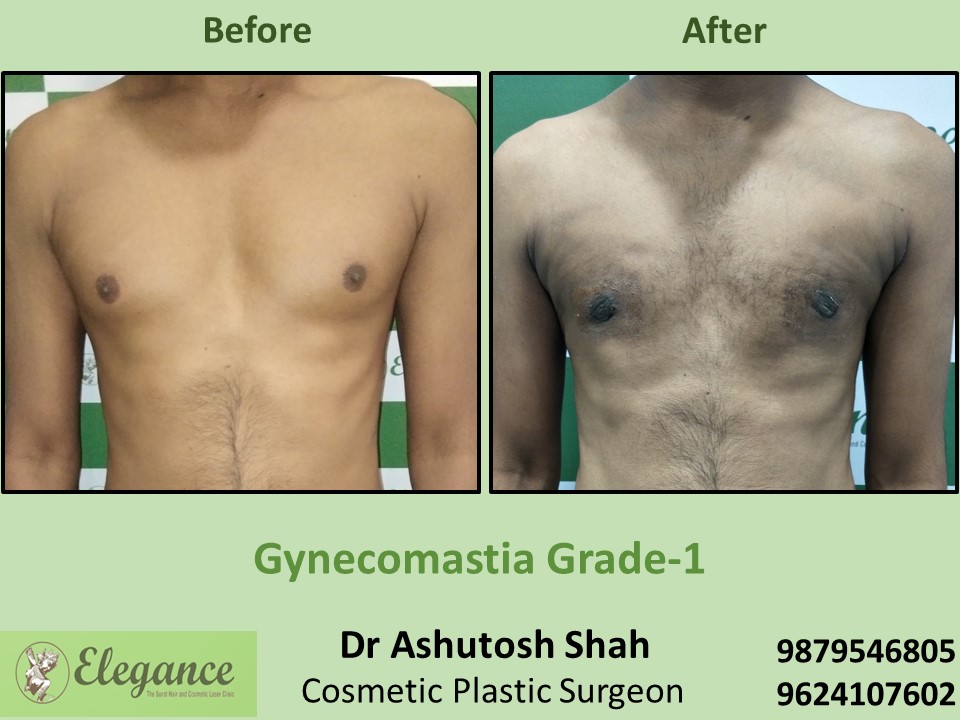 Large breast in Male Surgery in Surat