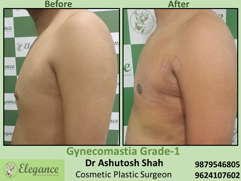 Male Breast Fat Removal Treatment in Olpad, Kawas, Surat