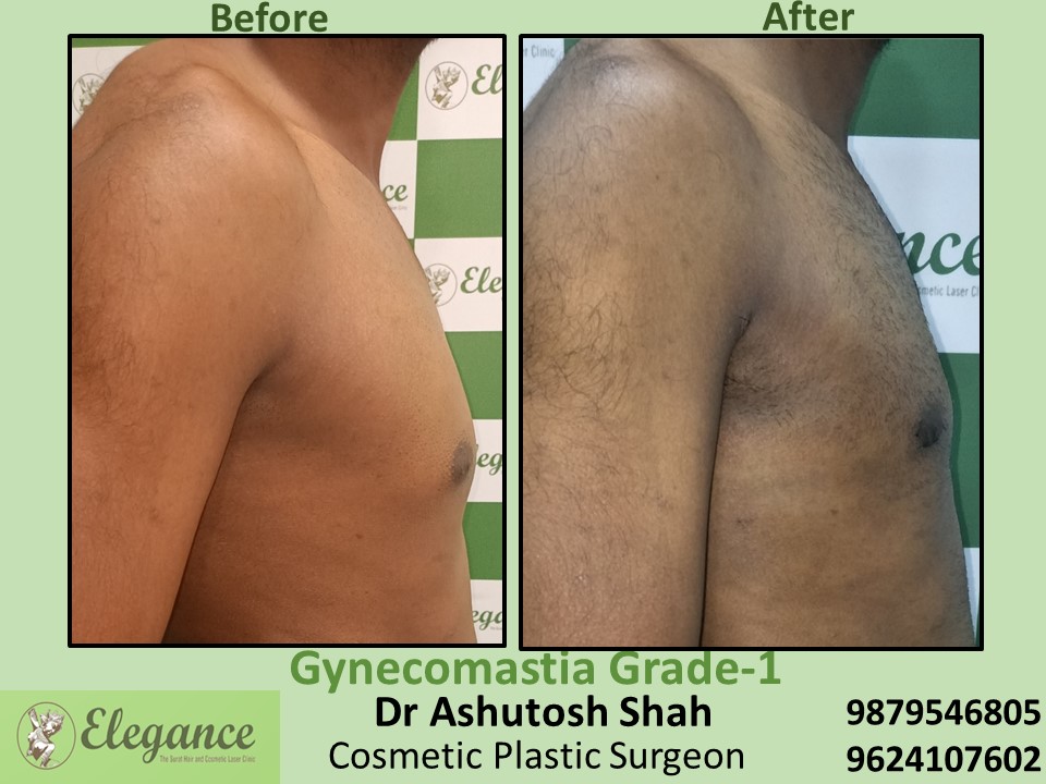 Male Breast Surgery in Piplod, Surat