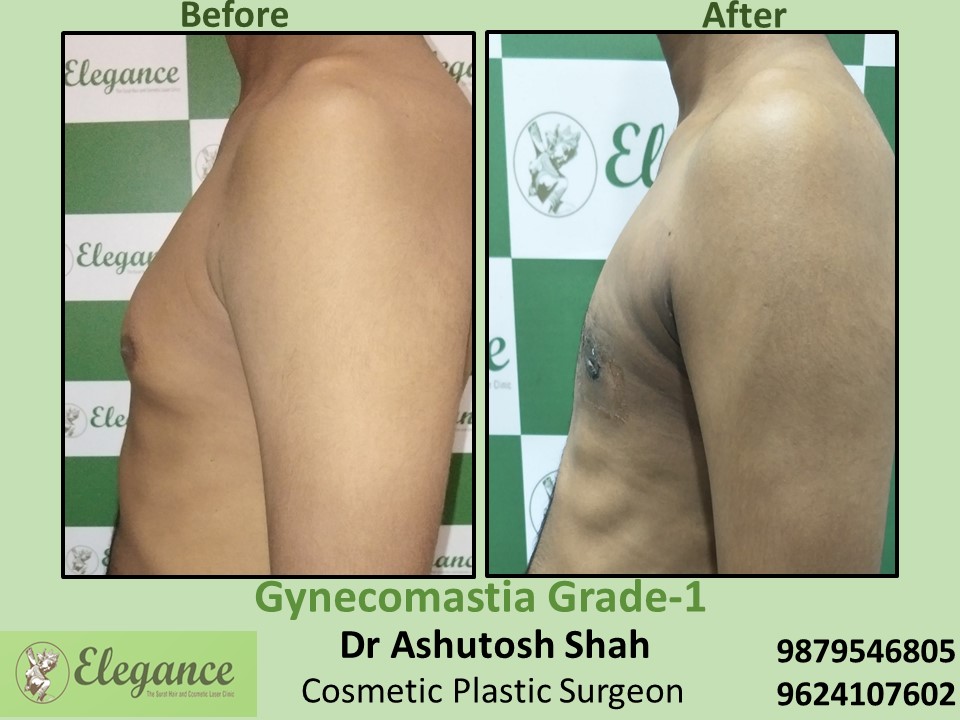 Removal of Fat in Breast at Surat