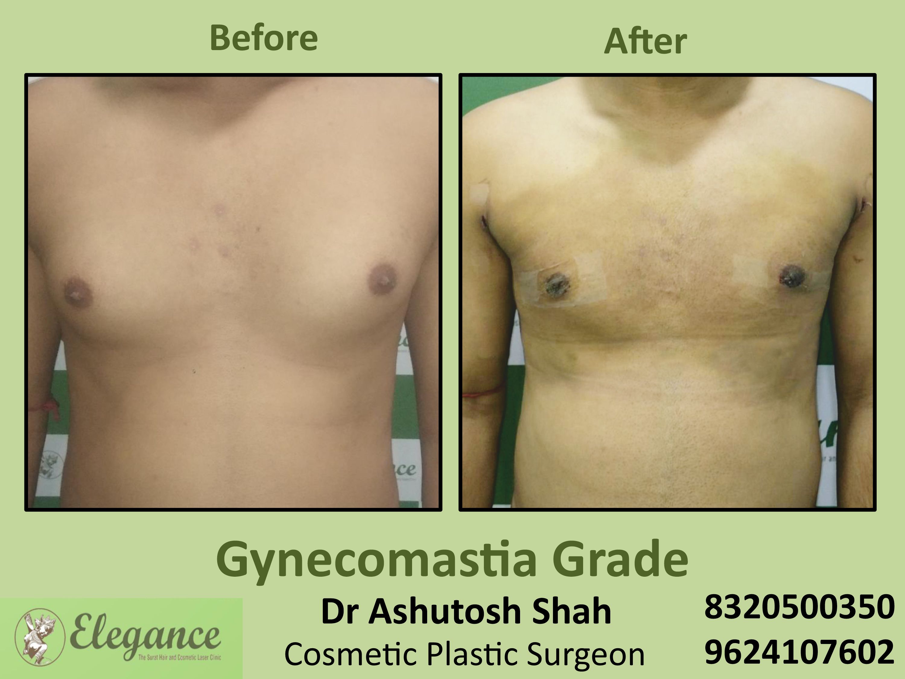 Male Boobs Surgery, Gynecomastia Surgery in Vesu, Surat