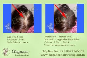 Hair Fiber Treatment in Bardoli, Gujarat, India.