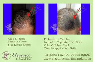Hair Fiber Treatment in Bharuch, Gujarat, India.