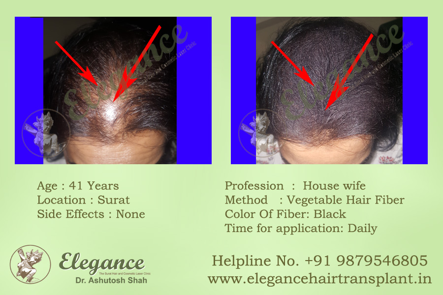 Hair Fiber Treatment in Selvasa, Gujarat, India.