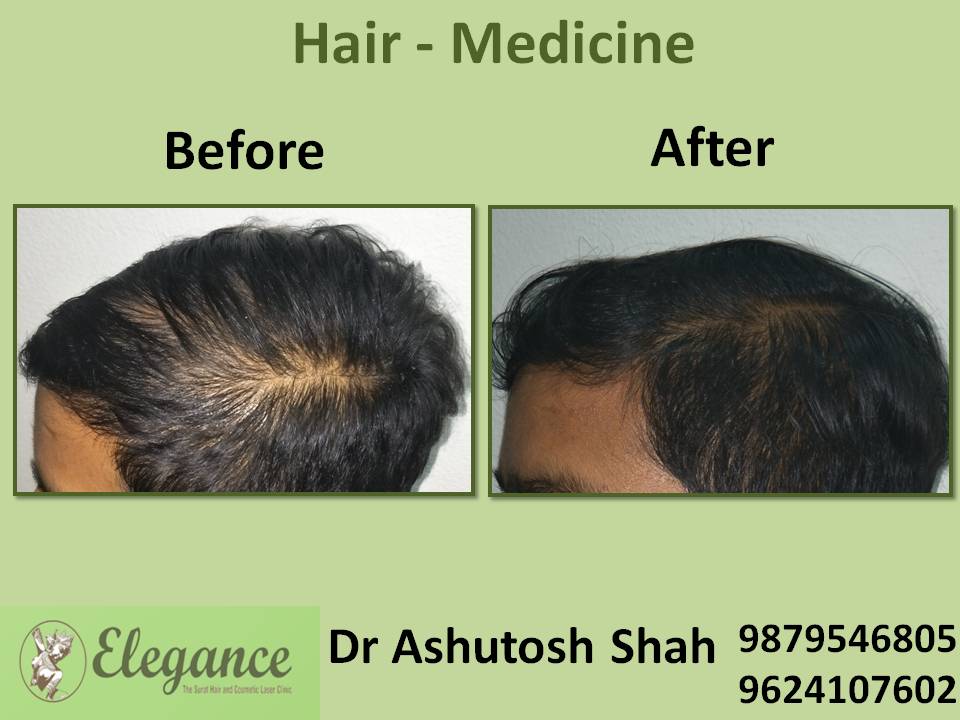 Hair Loss Medicine, Bardoli, Gujarat, India.