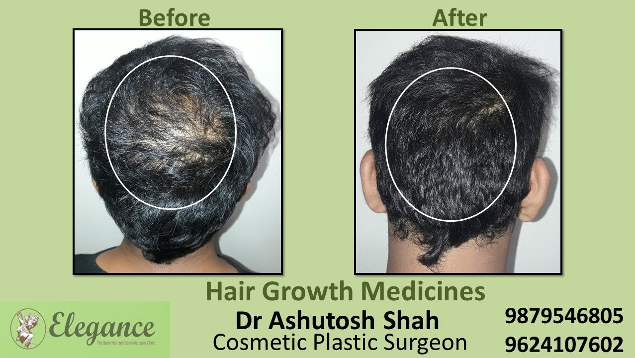 Hair Loss Medicine in Ahemdabad, Gujarat, India.