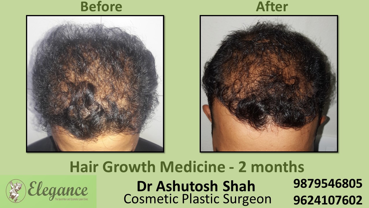 Hair Loss Medicine in Bharuch, Gujarat, India