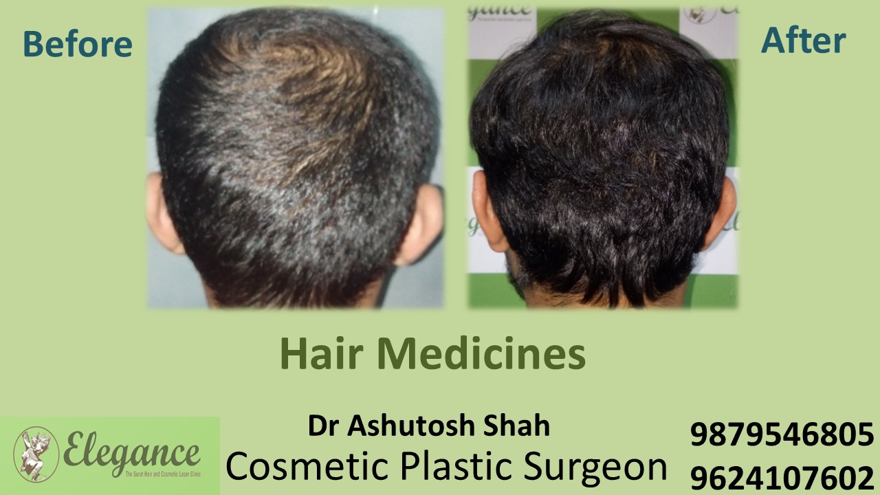 Hair Loss Medicine in Chhota Udaipur, Gujarat, India.