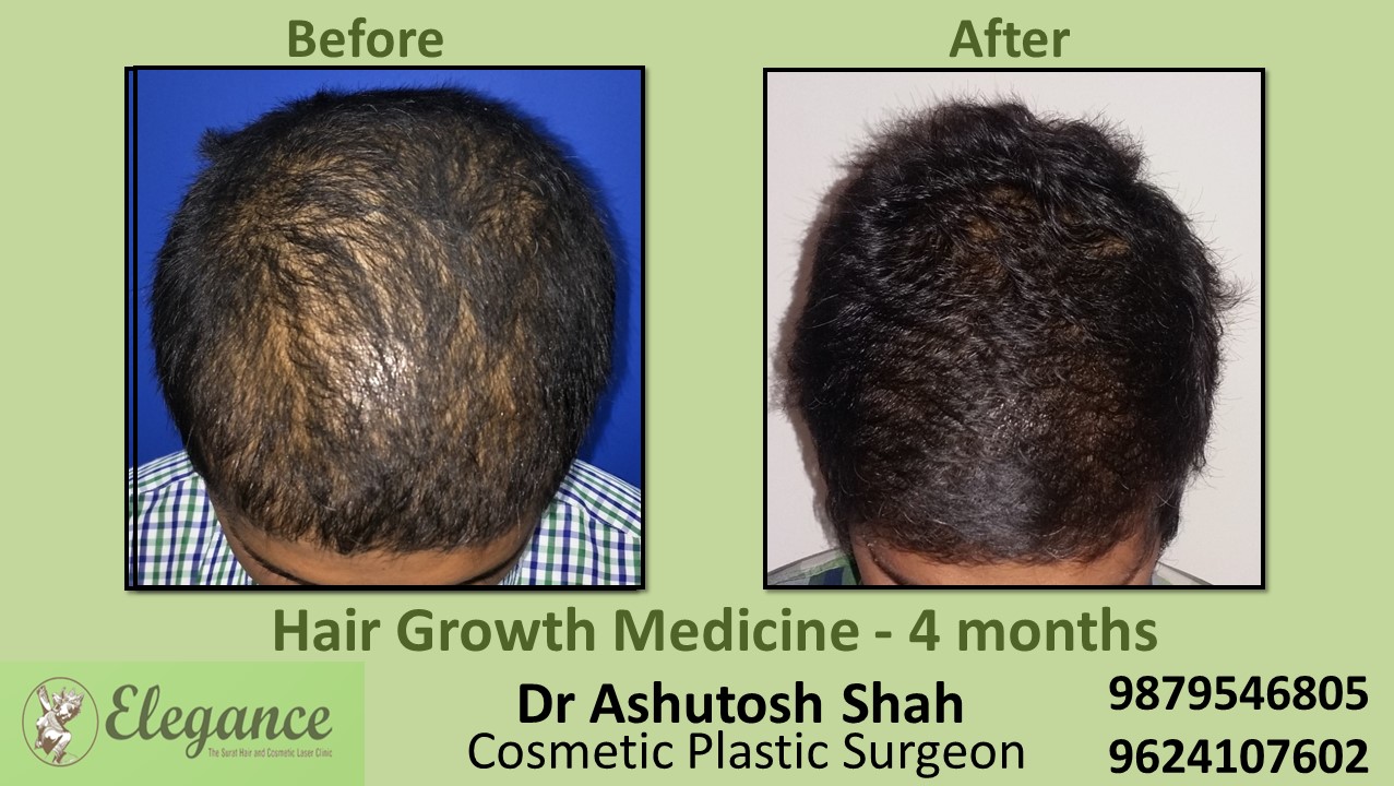 Hair Loss Medicine in Kim, Gujarat, India.