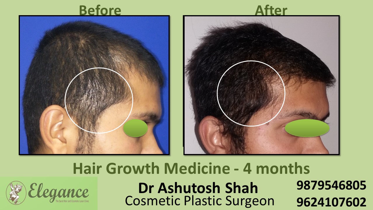 Hair Loss Medicine in Kosamba, Gujarat, India.
