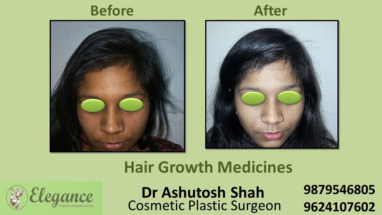 Hair Loss Medicine in Mangrol, Gujarat, India.