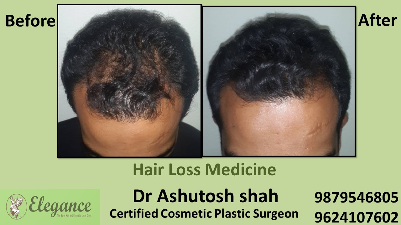 Hair Loss Medicine In Surat