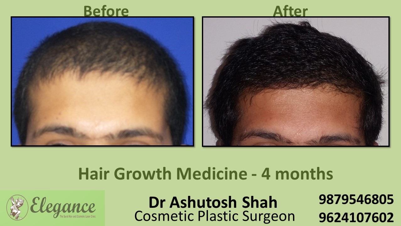 Hair Loss Medicine in Valsad, Gujarat, India.