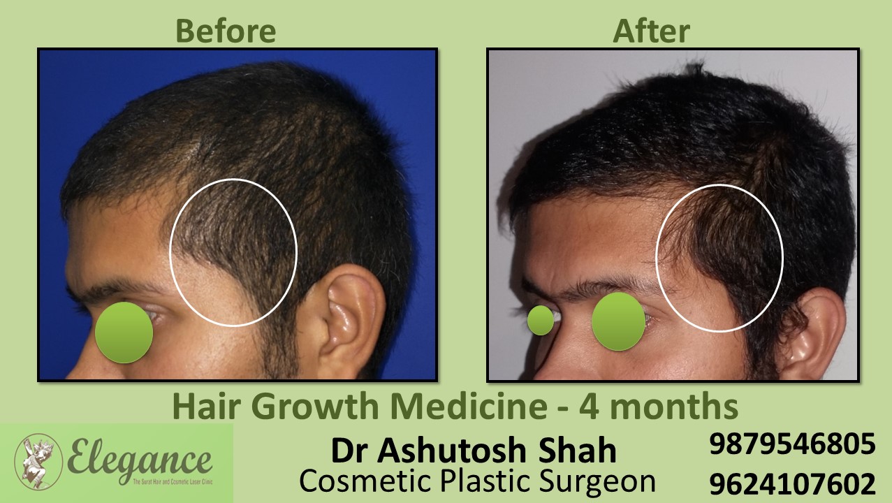 Hair Loss Medicine in Vapi, Gujarat, India.