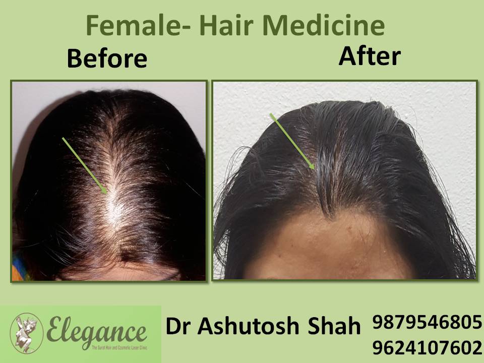 Hair Loss Medicine, Navsari, Gujarat, India.