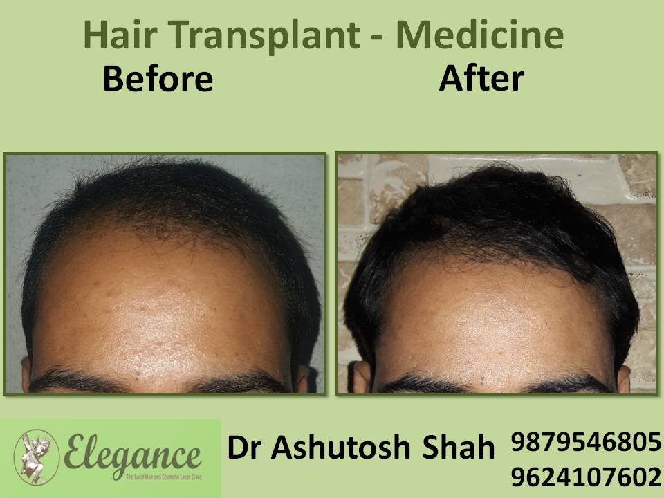 Hair Loss Medicine Treatment, Ankleshwar, Gujarat, India.