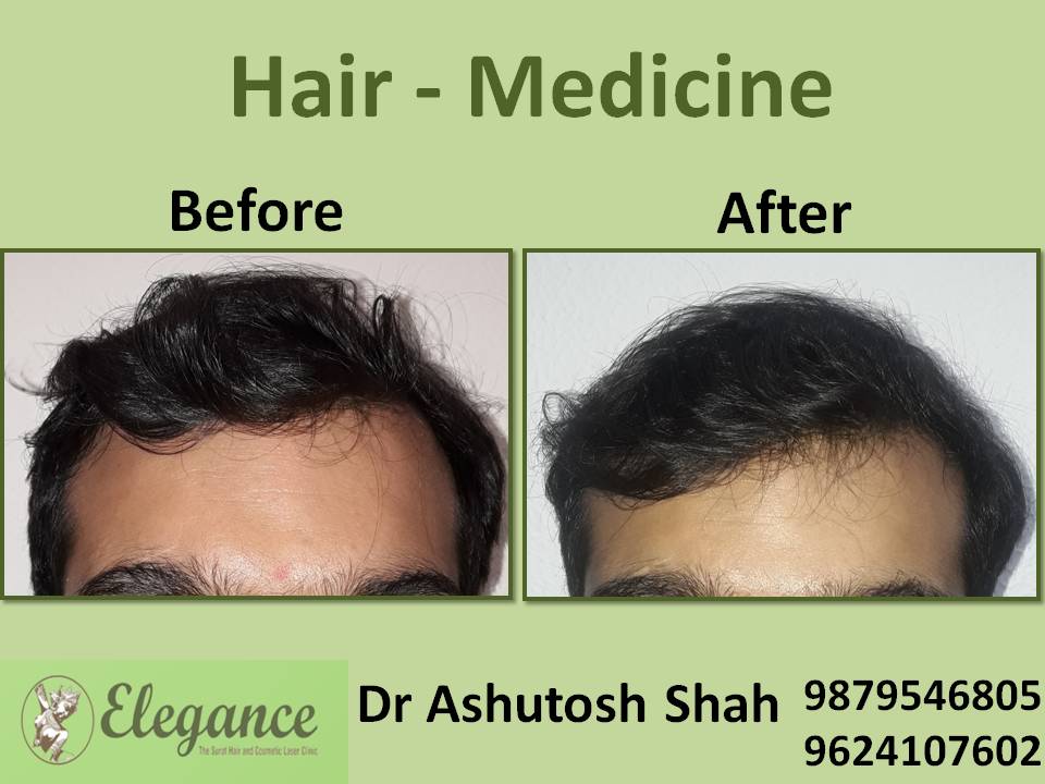 Hair Loss Medicine Treatment, Bharuch, Gujarat, India.