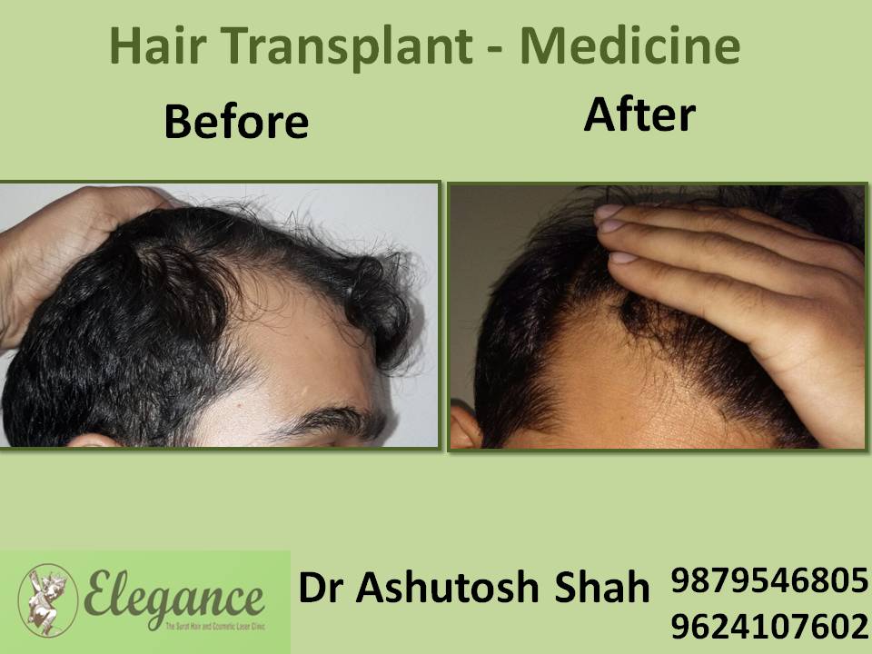 Hair Loss Medicine Treatment, Chhota Udaipur, Gujarat, India.