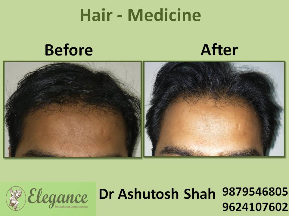 Hair Loss Medicine Treatment, Daman, Gujarat, India.