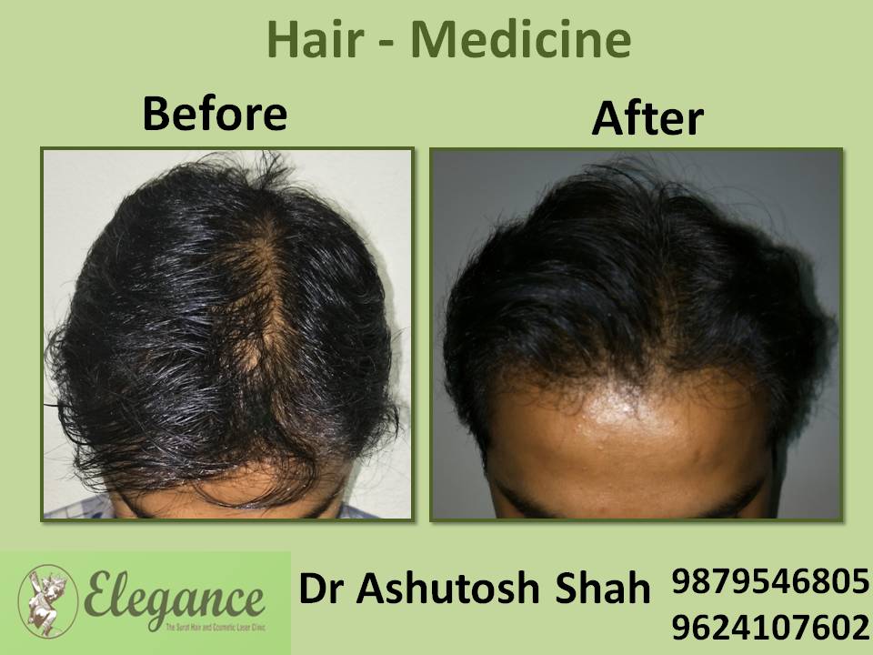 Hair Loss Medicine Treatment, Kosamba, Gujarat, India.